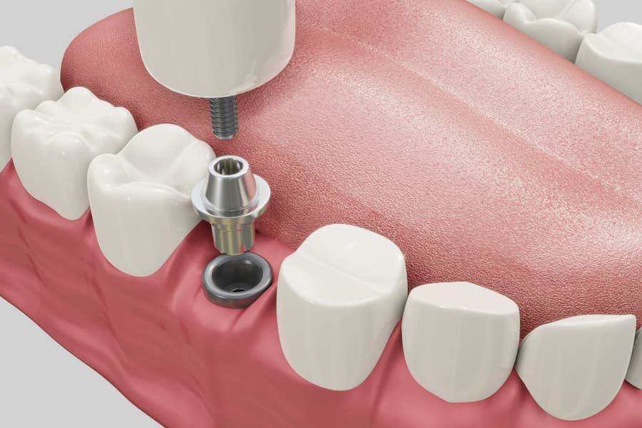 implants dentaires en titane