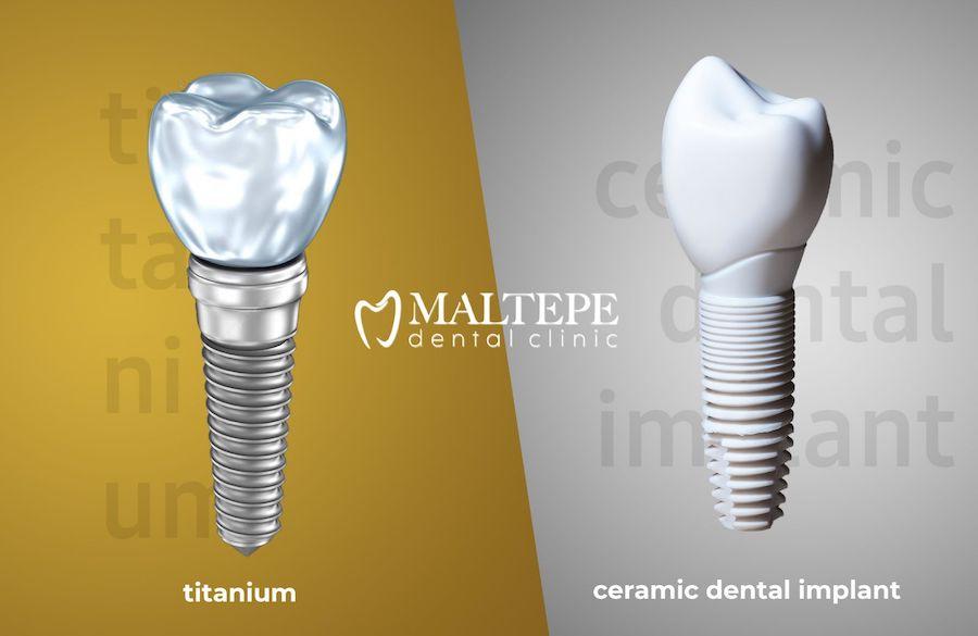 Implants dentaires en céramique ou en titane